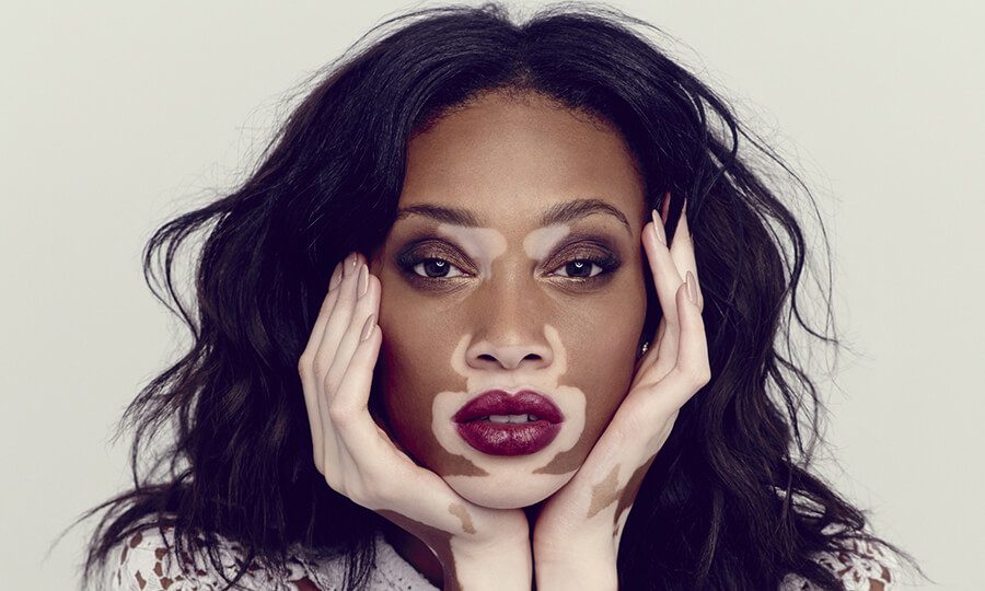 Saiba mais sobre o Vitiligo